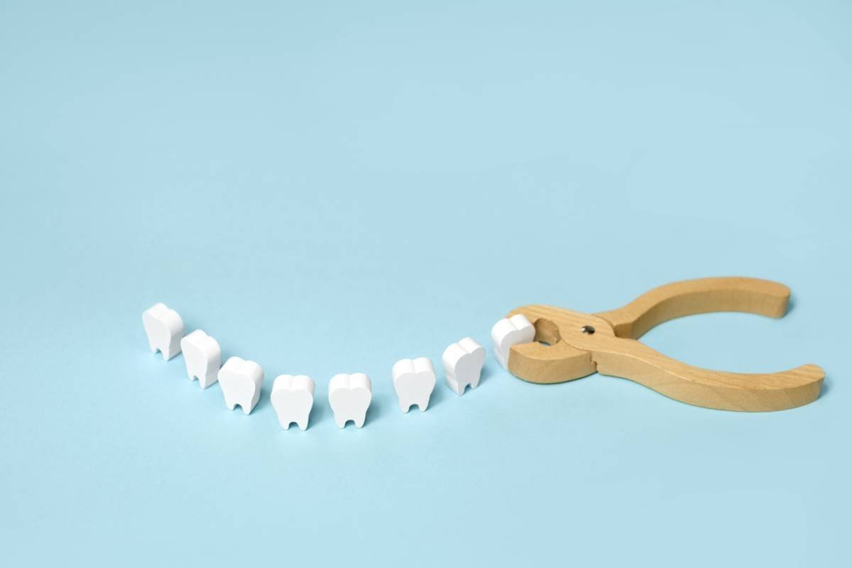 featured image for wisdom teeth anesthesia options